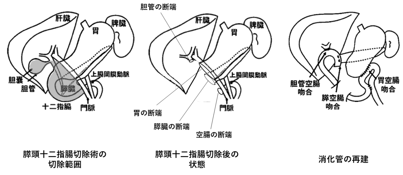 Q53. 膵臓癌の手術について教えてください | Junichi Shindoh, MD, PhD